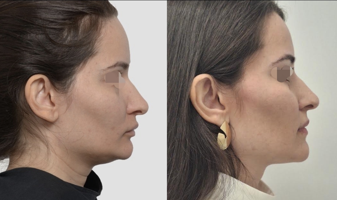 Perfil de paciente antes e depois — linha do queixo desenhada e pescoço rejuvenescido
