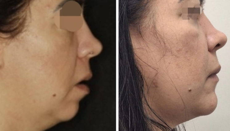 Perfil de paciente antes e depois — contorno mandibular e pescoço redefinidos