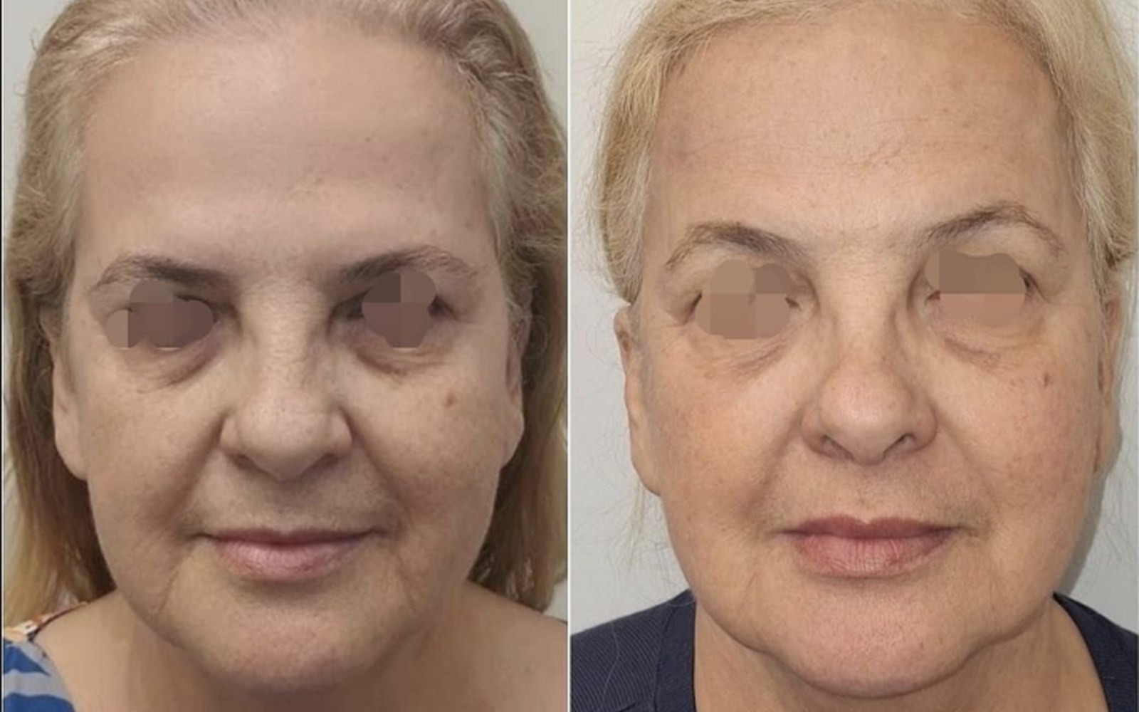Frontal de paciente antes e depois: traços mais firmes e sinais de cansaço apagados