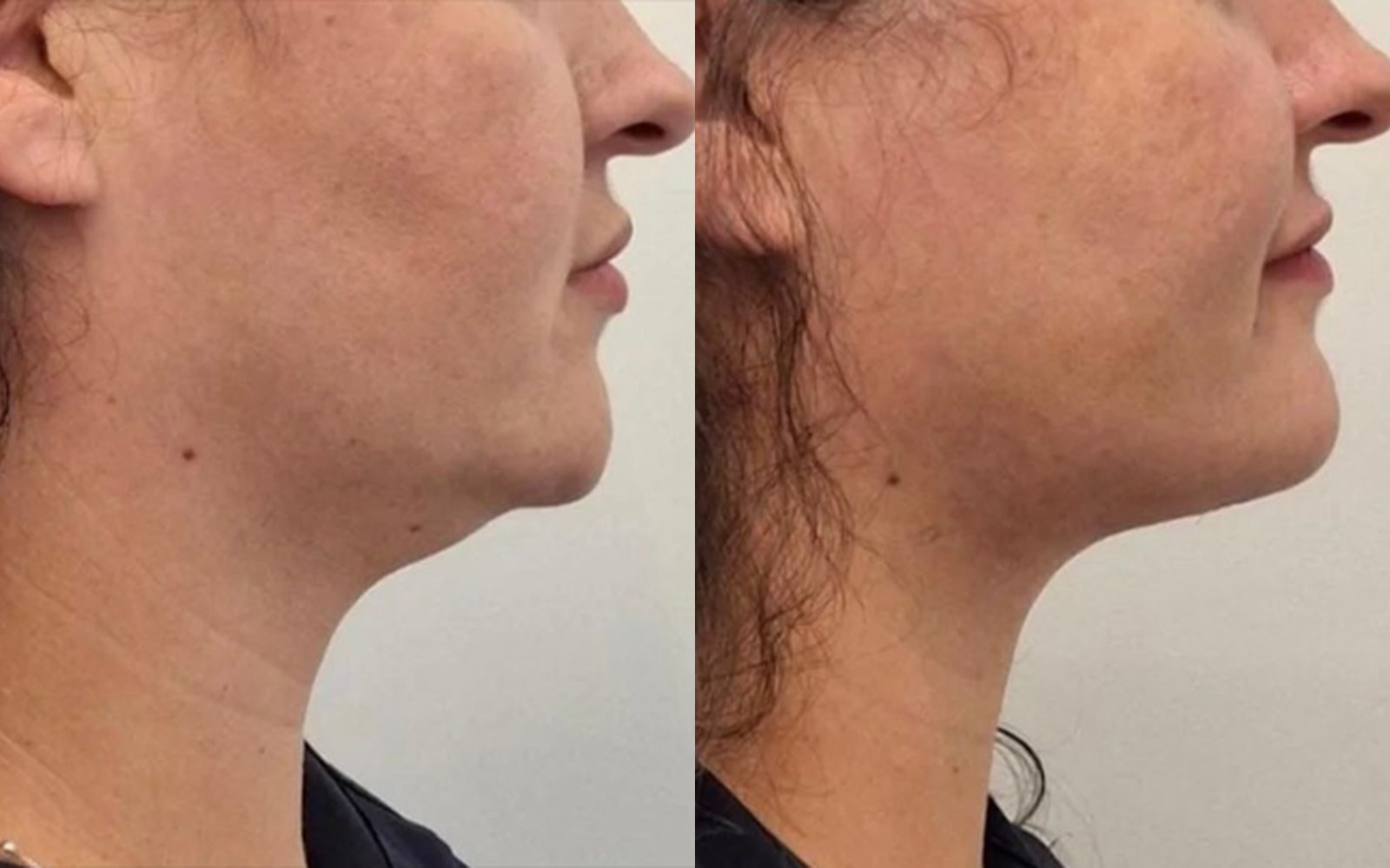Perfil de paciente antes e depois: linha do queixo desenhada e pescoço rejuvenescido