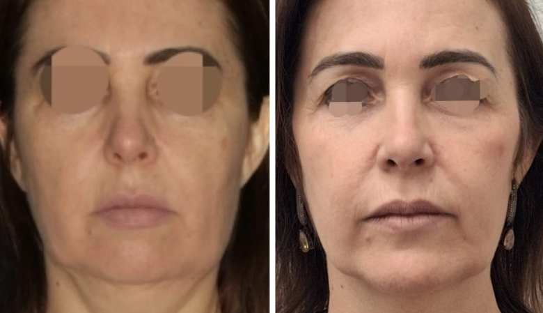 Frontal de paciente antes e depois — flacidez tratada mantendo naturalidade