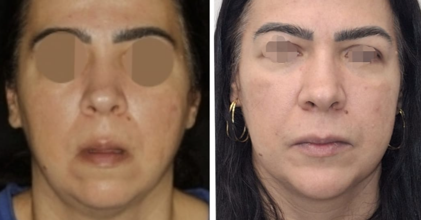 Frontal de paciente antes e depois — traços mais firmes e sinais de cansaço apagados