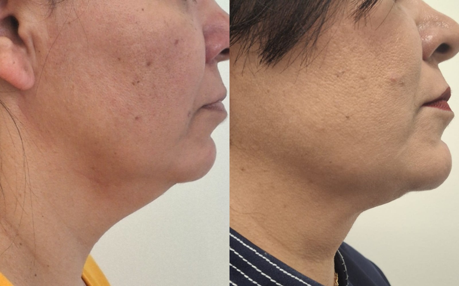 Perfil de paciente antes e depois: flacidez tratada mantendo naturalidade
