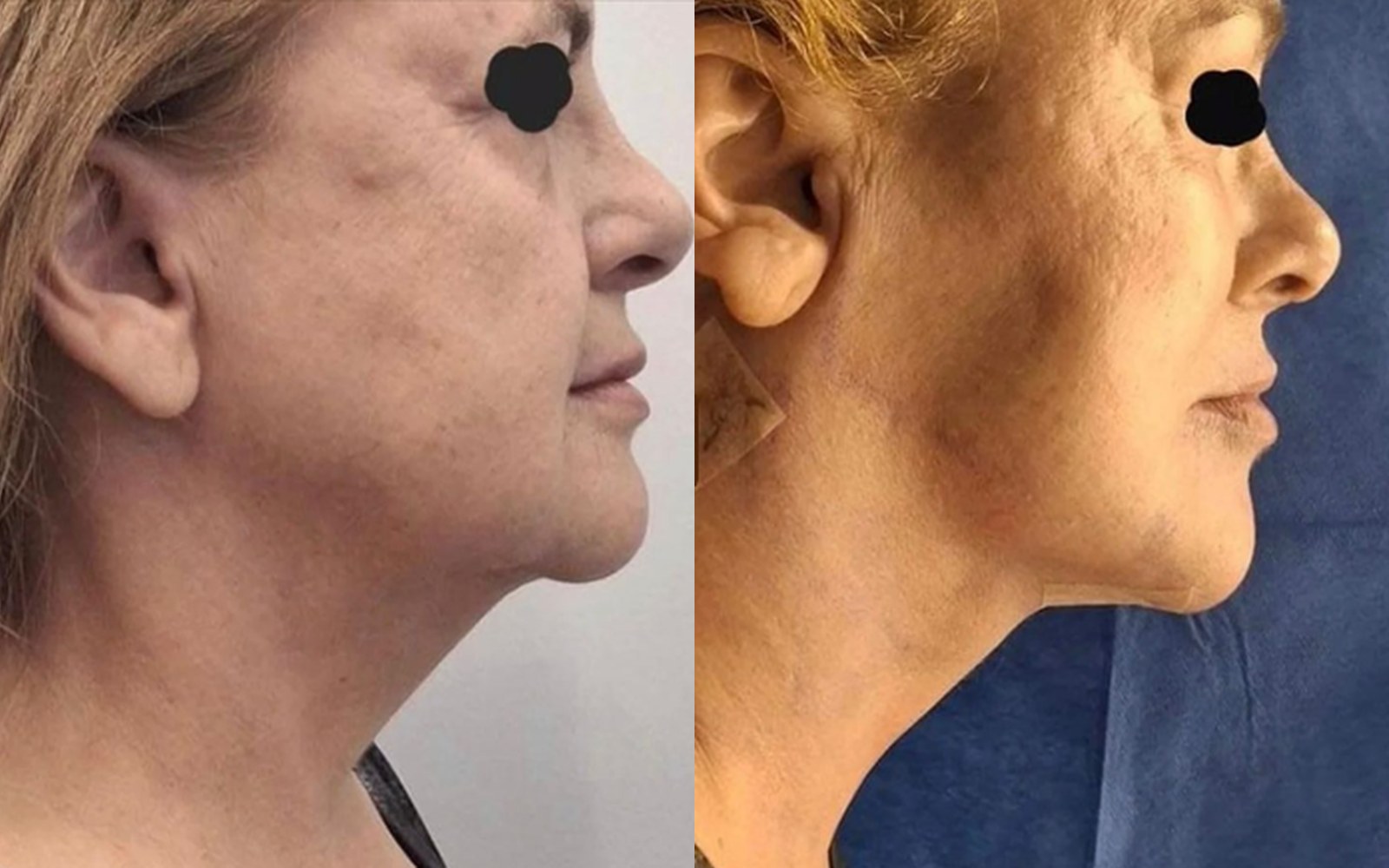 Perfil de paciente antes e depois: contorno mandibular e pescoço redefinidos